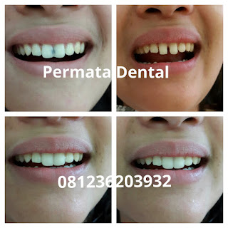 veneer bikin gigi kelinci bali| gigi kelinci denpasar| gigi kelinci ngurah rai |  gigi kelinci jimbaran| pasang gigi kelinci nusa dua | pasang gigi kelinci kute | pasang gigi kelinci gatsu | pasang gigi kelincibadung | pasang gigi kelinci bagus | pasang gigi kelinci murah | gigi kelinci di ahli gigi | gigi kelinci permanen | pasang gigi kelinci aman | pasang gigi kelinci cepat| Harga pasang gigi kelinci   | pasang gigi mudah | pasang gigi kelinci cantik| foto gambar gigi kelinci sebelum dan sesudah | gigi kelinci promo | trend foto gambar gigi kelinci | bunny smile