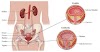 Urinary Tract Infection (UTI) - 4 Nursing Diagnosis Interventions