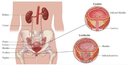 Urinary Tract Infection (UTI) - 4 Nursing Diagnosis Interventions