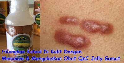 Cara menghilangkan keloid