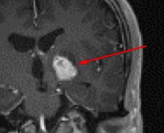 Right & Left Thalamic Lesions Symptoms, Causes, Treatment