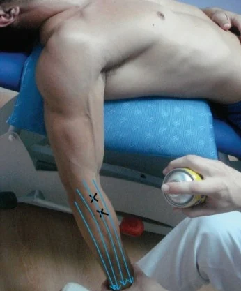 Técnica de spray & stretching en la musculatura epicondílea