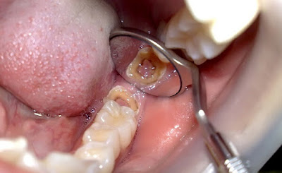 Răng bị sâu chỉ còn chân răng có nên giữ lại?