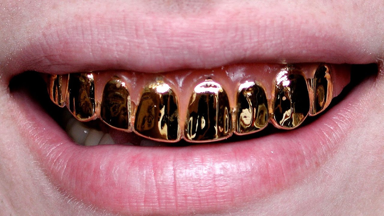 Gold Braces For Teeth