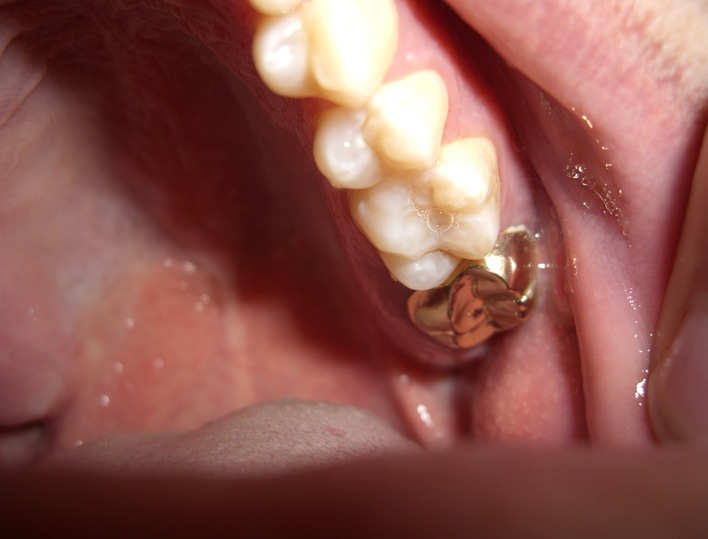 20091103 air's gold tooth (5)