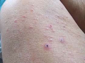 leg with larval tick bites