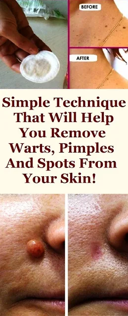 Removes Warts, Pimples And Spots From Your Skin With This Natural Recipe