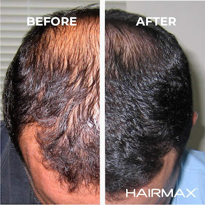hairmax laserband 82 results