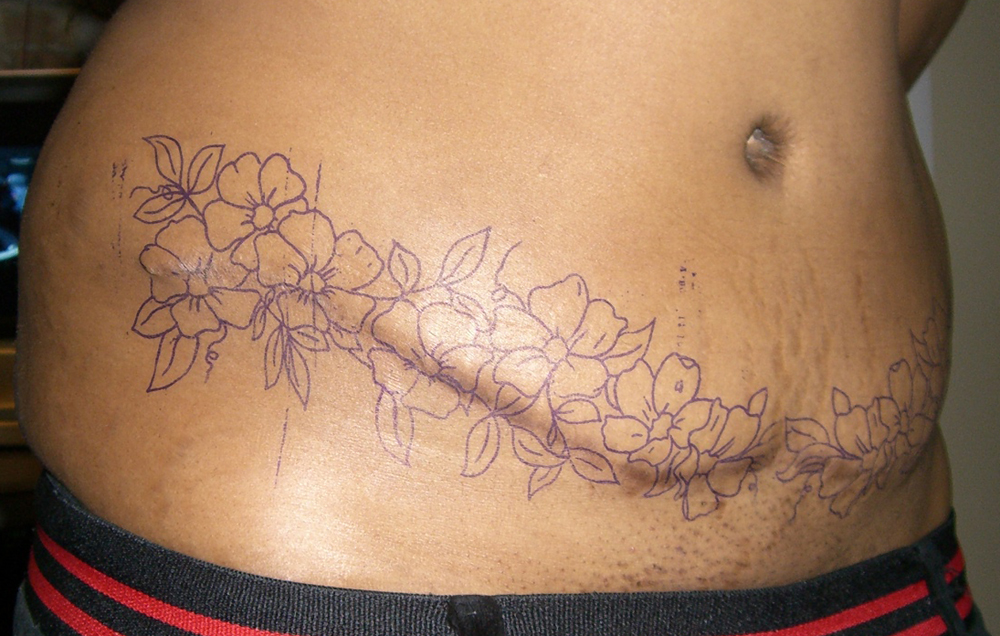 Can you remove a tattoo permanently without scarring? Tattoo Removal