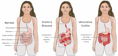 Understanding Ulcerative Colitis: Symptoms, Causes, and Management.