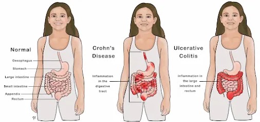 Understanding Ulcerative Colitis: Symptoms, Causes, and Management.