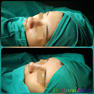 Thick Skin Bulbous Tip Rhinoplasty, Thick Skinned Nose Job, Female Rhinoplasty, Deviated Nose Aesthetic, Ethnic Rhinoplasty