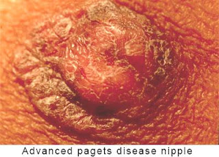 Paget's Disease, paget's disease adalah, paget's disease radiology, paget's disease signs, paget's disease of skin, paget's disease nipple vs eczema, paget's disease bone, paget's disease of breast, paget's disease of nipple, paget's disease breast ultrasound, paget's disease pathophysiology, paget's disease medscape, paget's disease extramammary, paget's disease ct scan,