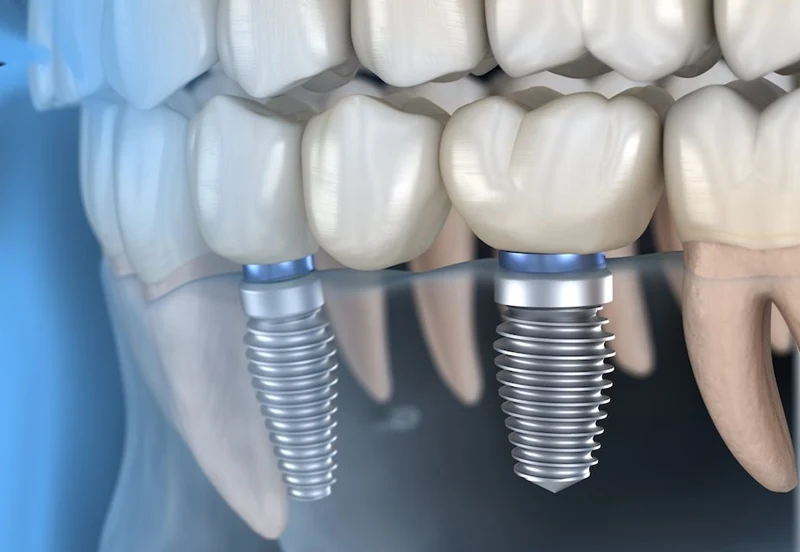 Dental implant tedavisi süreci