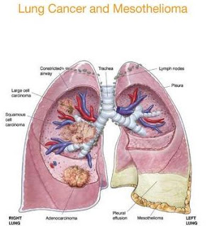mesothelioma peritoneal radiology