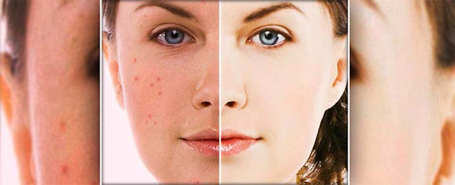 remedios-soluciones-espinillas-acne