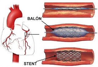 Angioplastia  colonaria |aterosclerosis|