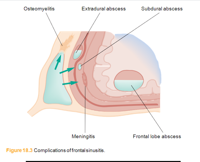 Complications of frontal sinusitis