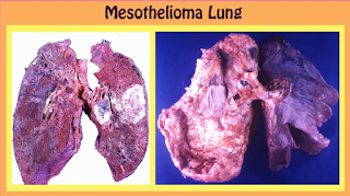 lung mesothelioma