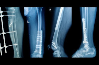 arthrogryposis multiplex congenita, knee contractures, flexion contractures, management of knee and flexion contractures, 