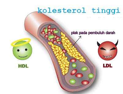 kolesterol tinggi