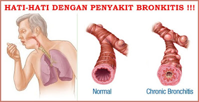 Gejala Dan Penyebab Bronkitis