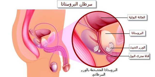 سرطان-البروستاتا