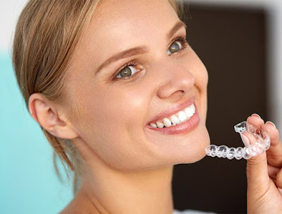Quy trình niềng răng invisalign như thế nào? 1