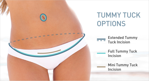 tummy tuck in delhi