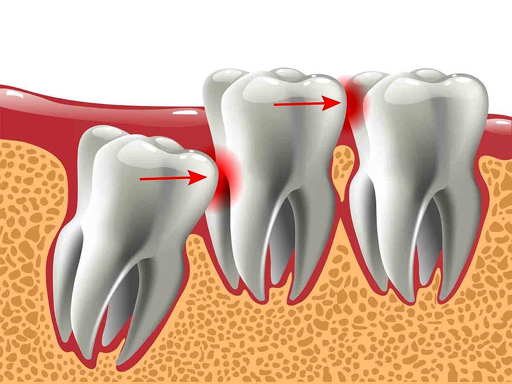 Dente do siso