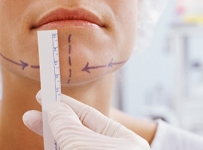 Chin Augmentation Surgery