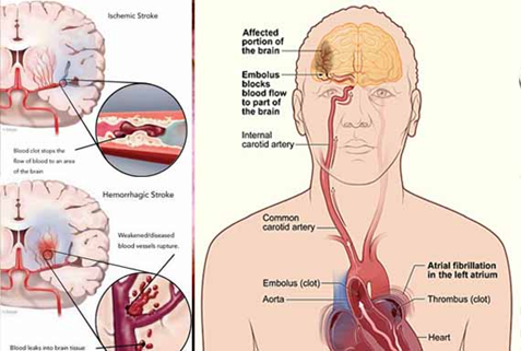 Dengan begitu banyaknya masalah stroke di  Penyebab Stroke