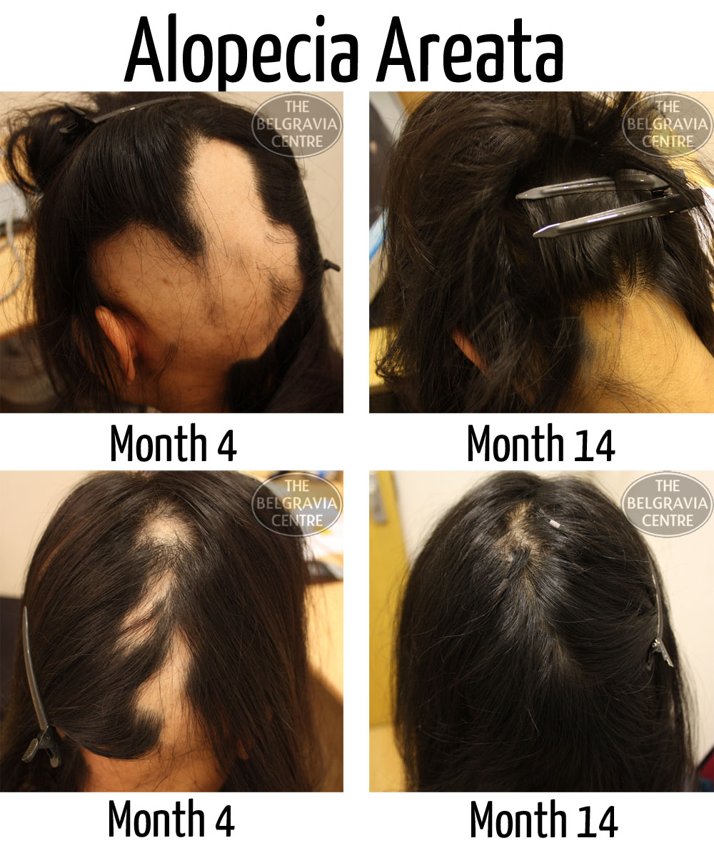 Treating Alopecia Areata In Women The Belgravia Centre