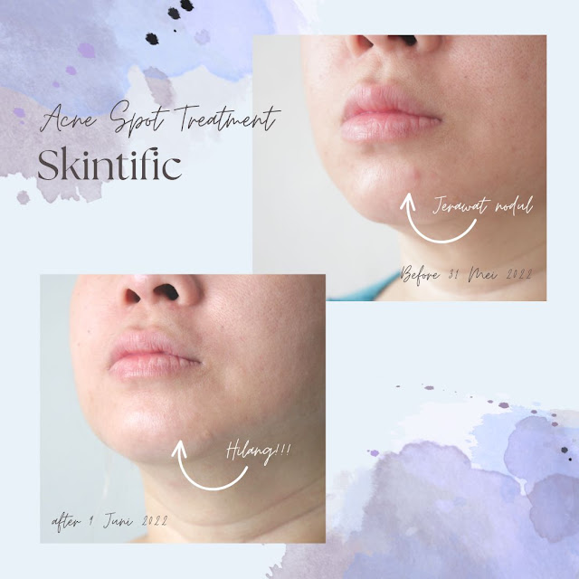 Skintific-Acne-Spot