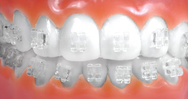 Biaya dan Tarif Pasang Kawat Gigi dan Gigi Palsu Di 