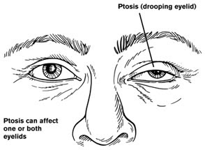 Nursing Diagnosis for Myasthenia Gravis