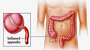 Pengobatan Radang Usus Buntu Terbaik