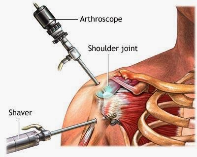 Shoulder Replacement Surgery Cost