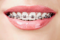 spannhake orthodontics 