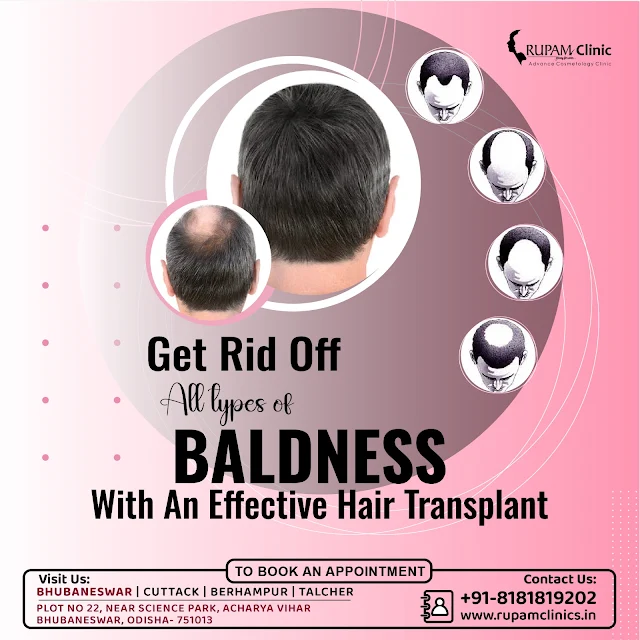 Hair Transplant Treatment Clinic
