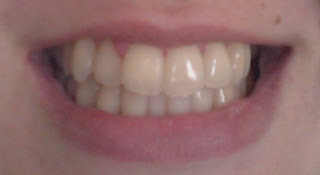 Plus White 5 minute speed whitening system before