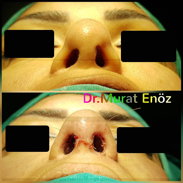 Tertiary Revision Nose Tip Plasty, 3rd Revision Nose Tip Correction Surgery in Istanbul