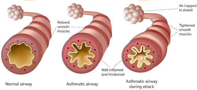 SYMPTOMS OF ASTHMA