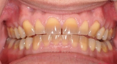 Nguyên nhân khiến răng bị sẩm màu