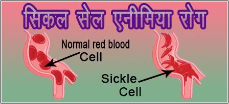 sickle cell anemia disease image