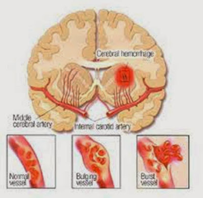 rawat stroke dgn vivix shaklee