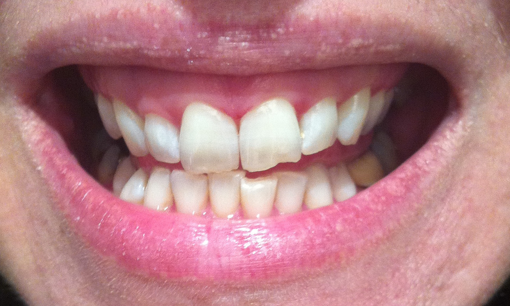 Zoom2! Tooth Whitening at The Welbeck Clinic - Get Lippie