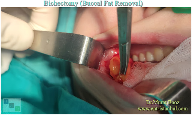 Bichectomy, Buccal Fat Removal, Buccal fat extraction, Hollywood cheek, Cheek Thinning Surgery, Cheek Fat Removal, Extended buccal lipectomy