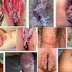 Kenapa daging tumbuh di vagina