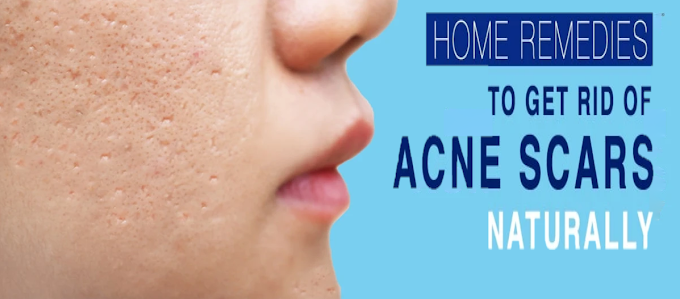 Acne scars-How to get rid of acne scars